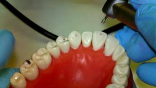 Occlusal Equilibration [upl. by Lashonda715]