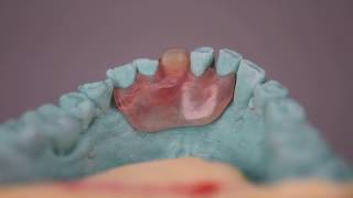 Valplast Flexible Denture [upl. by Tess]