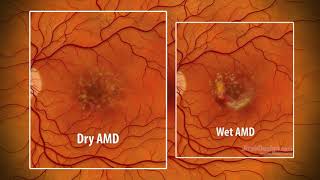 AgeRelated Macular Degeneration Exudative Fundoscopy [upl. by Halak407]