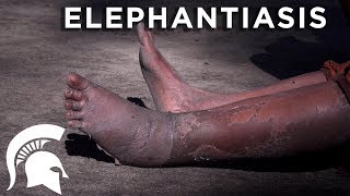 Spartans fight elephantiasis in Tanzania [upl. by Elyk]