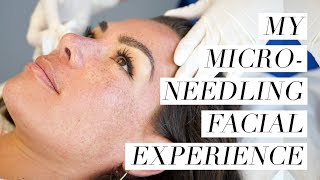 My Microneedling Facial Experience [upl. by Rhines]