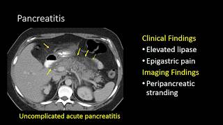 GI Imaging  Pancreatitis [upl. by Rubinstein721]