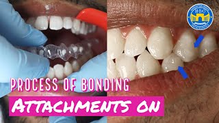 How Invisalign Attachments are placed [upl. by Noyr839]