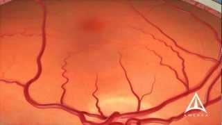 Dry Macular Degeneration [upl. by Marutani]