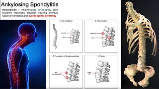 Ankylosing Spondylitis  Mechanism Risk Factors amp SignsSymptoms [upl. by Cowan]