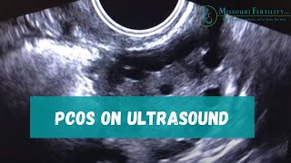 PCOS Sonogram and Discussion [upl. by Tresa598]