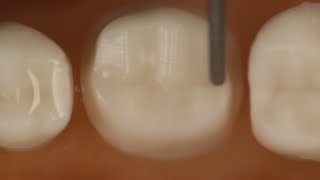 PFM Crown Posterior Tooth Preparation With Metal Occlusal [upl. by Capon899]