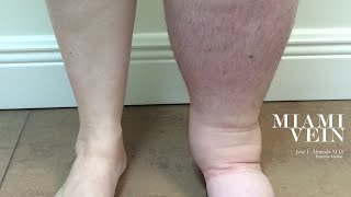 Got EDEMA 11 Medications that Cause Leg Swelling 2024 [upl. by Yra]