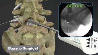 Sciatica Surgery Dr John Small  Florida Orthopaedic Institute [upl. by Cynar496]