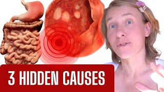 The Hidden Truth What REALLY Causes Gastritis SURPRISE [upl. by Abocaj]