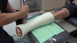 Removing and Bivalving a Cast [upl. by Chang]