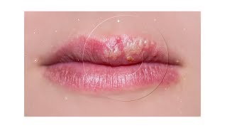 Mouth Ulcers Canker Sores in Children  Causes Symptoms amp Treatment [upl. by Lemhaj946]