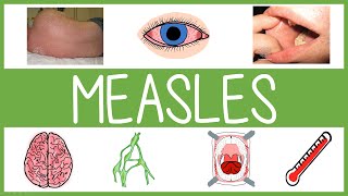 Measles  Features Management and Mnemonics [upl. by Arocahs]