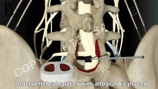 Lumbar Fusion of L5 S1 Posterior [upl. by Eimat]