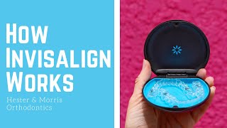 How Invisalign Works [upl. by Anoi]