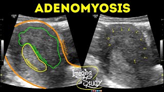 Adenomyosis  Ultrasound  Case 42 [upl. by Delinda410]