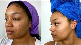 Chemical Peeling Before amp After  Procedure  Benefits  Dr Jagdish Sakhiya  Sakhiya Skin Clinic [upl. by Atarman]