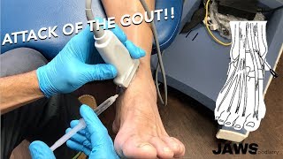 Injecting a GOUTy ankle joint [upl. by Nylrak522]