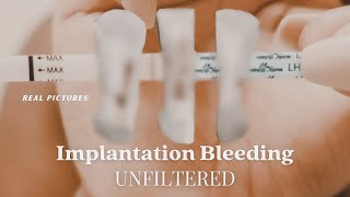 IMPLANTATION BLEEDING WITH PICTURES  Two Week Wait Bfp  Bfn Symptoms [upl. by Deeann]