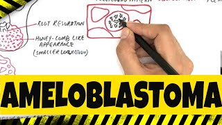 Ameloblastoma  Origination Clinical Radiographic amp Histopathologic features [upl. by Tsenre]