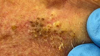 Extremely Clogged Pores Extracted  Contour Dermatology [upl. by Auqemahs]