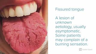 BURNING MOUTH SYNDROME An Oral Pathologists Perspective [upl. by Maite]