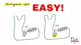 Dentigerous cyst made easy [upl. by Marchese]