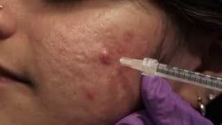 Watch amp Learn Intralesional injections [upl. by Edijabab867]