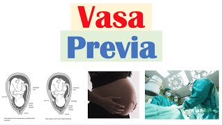 Vasa Previa Obstetrical Condition  Causes Risk Factors Signs amp Symptoms Diagnosis Treatment [upl. by Eelyr]