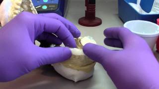 Bruxism Splint  Part 4  Developing the Occlusal Surface [upl. by Ravahs]