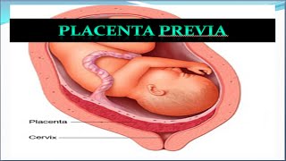 Placenta Previa Update [upl. by Aisanat]