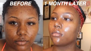 I FADED MY ACNE SCARS  GOT CLEAR SKIN DOING THIS FOR 1 MONTH VIDEO PROOF  SKINCARE ROUTINE [upl. by Dorette851]