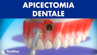 Apicectomia dentale © [upl. by Percy]