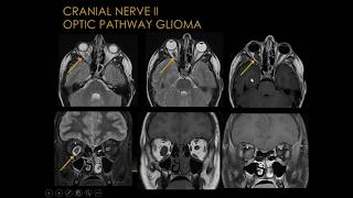 Lumbar Degenerative Disc Disease Part 1 Symptoms and Imaging [upl. by Tannenbaum655]