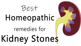 Best homeopathic medicine for stone in kidney  Dr Sanjay Panicker [upl. by Monafo535]