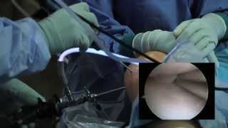 Arthroscopic Knee Surgery Meniscus Tear [upl. by Lyrradal366]