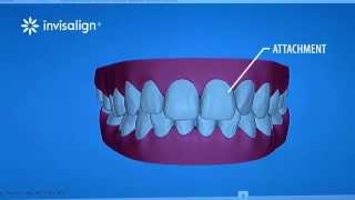 What You Can Expect During Invisalign Treatment [upl. by White980]