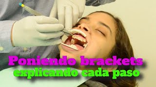 Como se Colocan los Brackets Paso a Paso [upl. by Liederman]