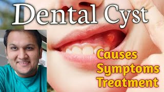 Dental Cyst and Infection Causes Symptoms Types and Treatment [upl. by Wolfson]