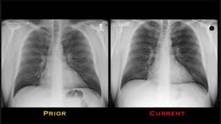 Pneumonia Explained by Prometheus Lionhart MD [upl. by Ahseya]