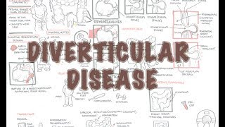 Diverticular Disease diverticulitis  Overview [upl. by Rogerio]