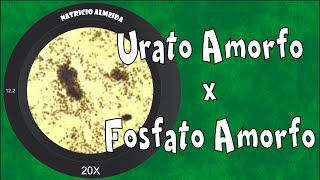 Cristais de urato amorfo e fosfato amorfo na urina [upl. by Oliver400]