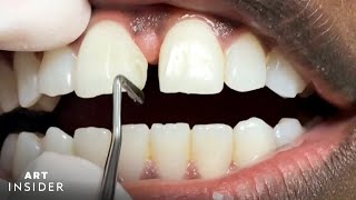 How Tooth Gaps Are Filled  Insider Art [upl. by Eniron487]