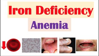 IronDeficiency Anemia Overview  Causes Pathophysiology Signs amp Symptoms Diagnosis Treatment [upl. by Odlanra]