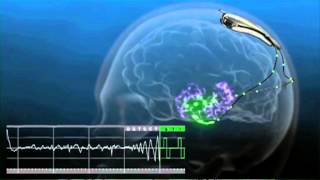 Absence Seizure hyperventilation test [upl. by Rawdan831]