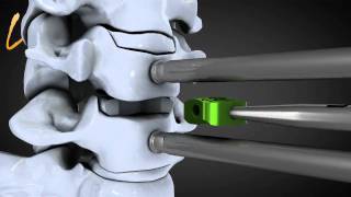 Hernie discale cervicale  Spinal disk herniation  Kisco International [upl. by Klepac]