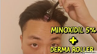 HOW TO USE DERMA ROLLER AND MINOXIDIL FOR HAIR GROWTH [upl. by Josee]