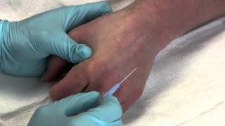 Intravenous Catheter Placement [upl. by Rosalinda]