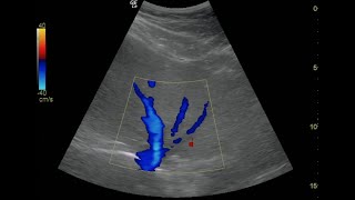 Hepatic Vein Doppler  Normal Flow [upl. by Eicirtap219]