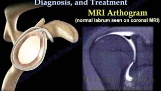 Meniscus Tears  Everything you need to know [upl. by Esiocnarf]